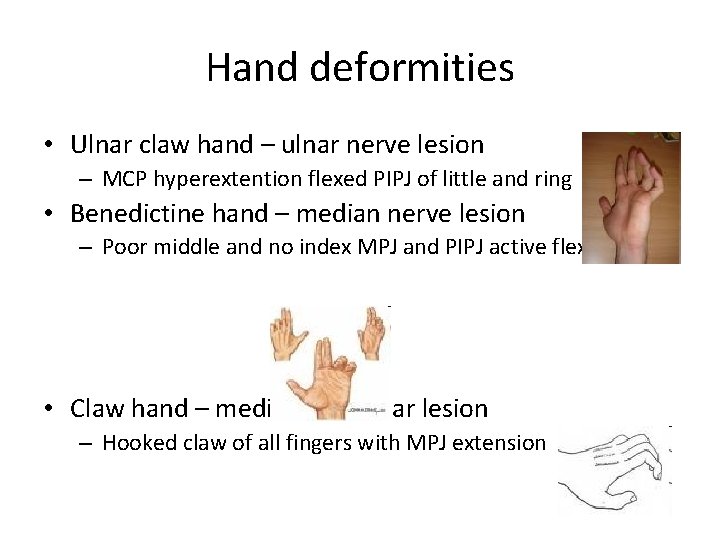 Hand deformities • Ulnar claw hand – ulnar nerve lesion – MCP hyperextention flexed