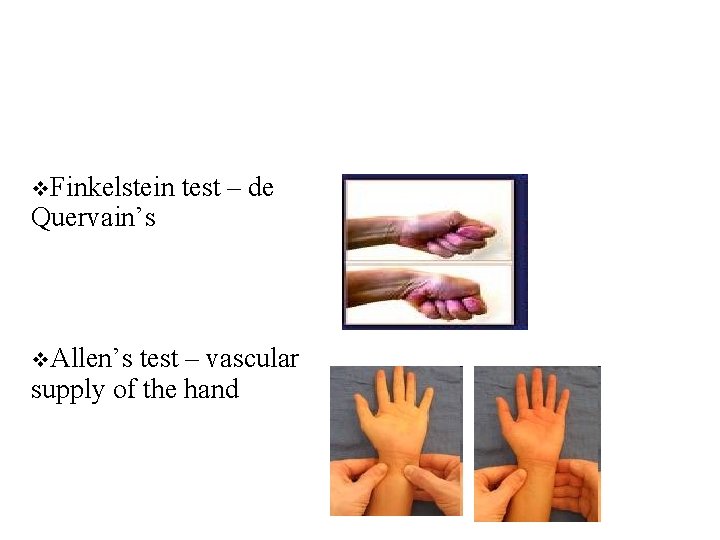 v. Finkelstein Quervain’s v. Allen’s test – de test – vascular supply of the