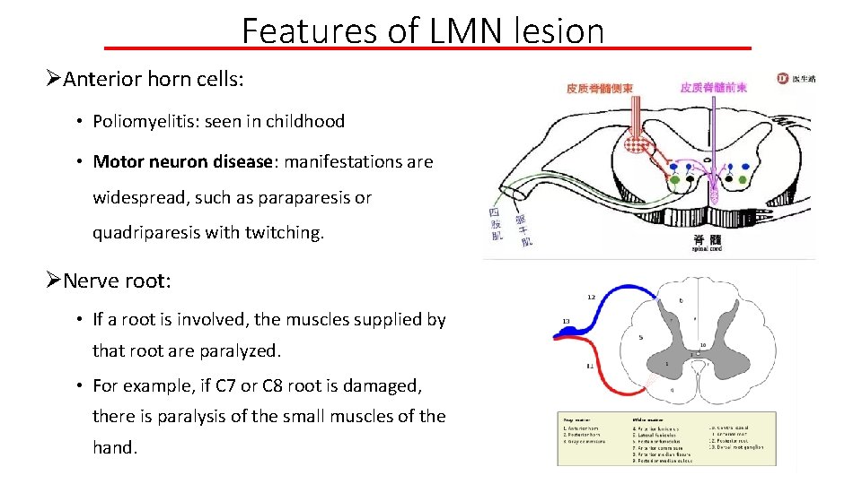 Features of LMN lesion ØAnterior horn cells: • Poliomyelitis: seen in childhood • Motor