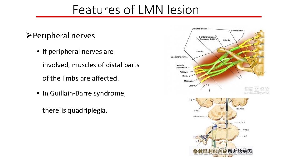 Features of LMN lesion ØPeripheral nerves • If peripheral nerves are involved, muscles of