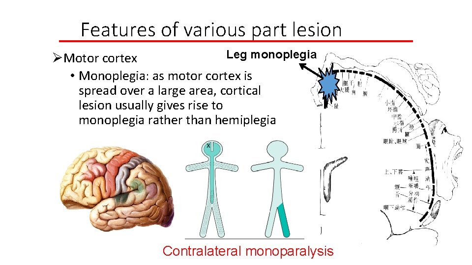 Features of various part lesion Leg monoplegia ØMotor cortex • Monoplegia: as motor cortex
