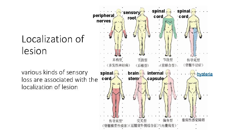 peripheral nerves sensory root spinal cord Localization of lesion various kinds of sensory loss