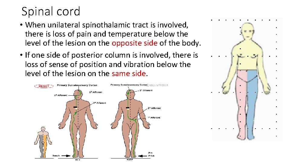 Spinal cord • When unilateral spinothalamic tract is involved, there is loss of pain