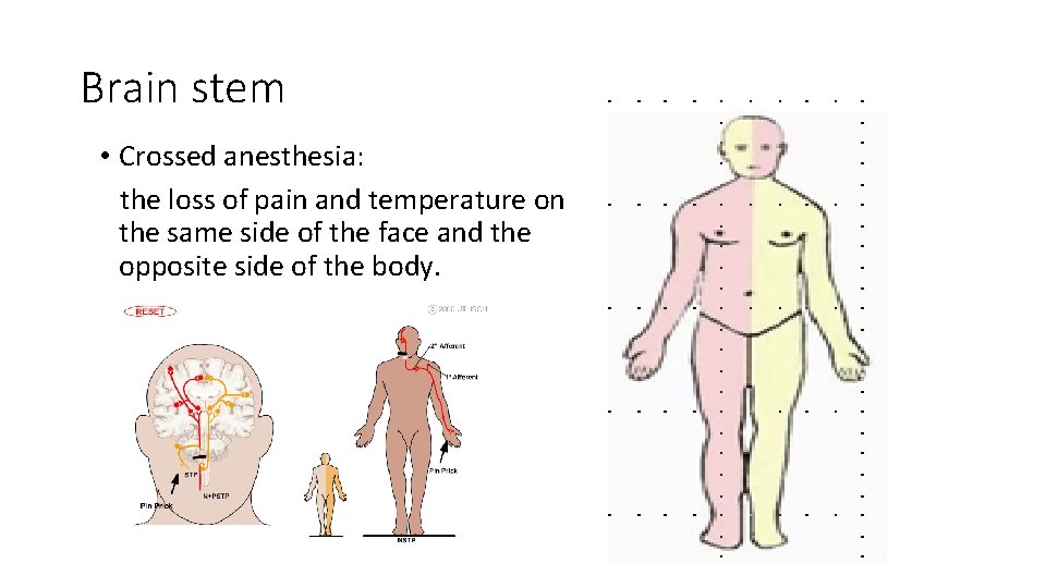 Brain stem • Crossed anesthesia: the loss of pain and temperature on the same