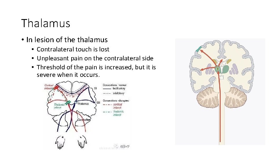 Thalamus • In lesion of the thalamus • Contralateral touch is lost • Unpleasant