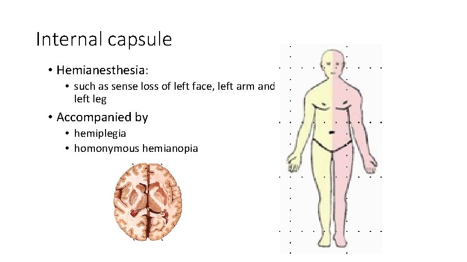 Internal capsule • Hemianesthesia: • such as sense loss of left face, left arm