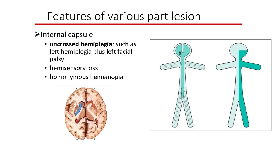 Features of various part lesion ØInternal capsule • uncrossed hemiplegia: such as left hemiplegia