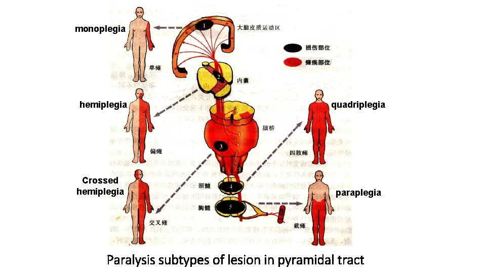 monoplegia hemiplegia Crossed hemiplegia quadriplegia paraplegia Paralysis subtypes of lesion in pyramidal tract 