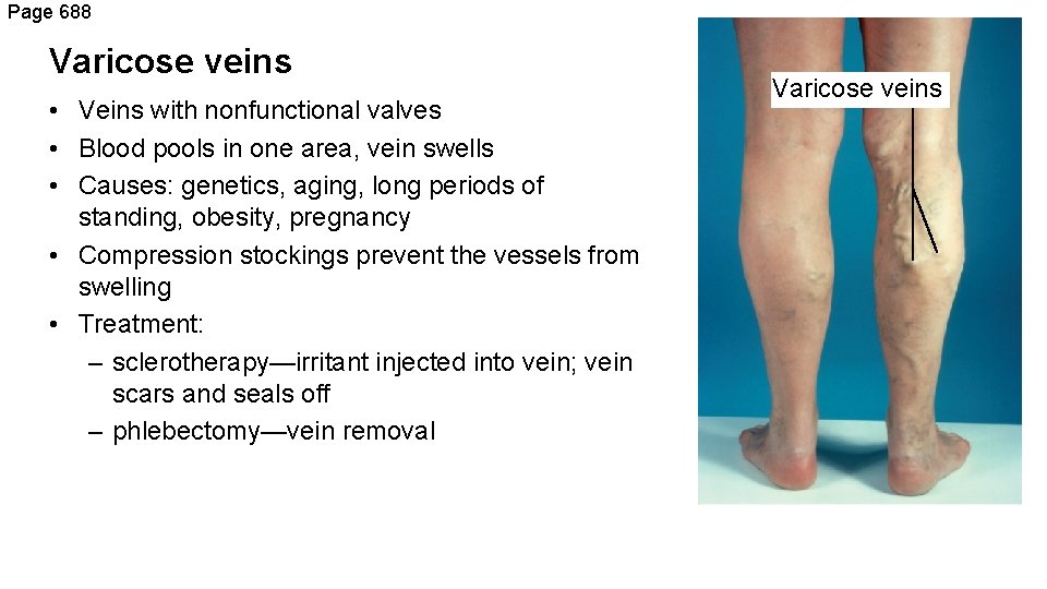 Page 688 Varicose veins • Veins with nonfunctional valves • Blood pools in one