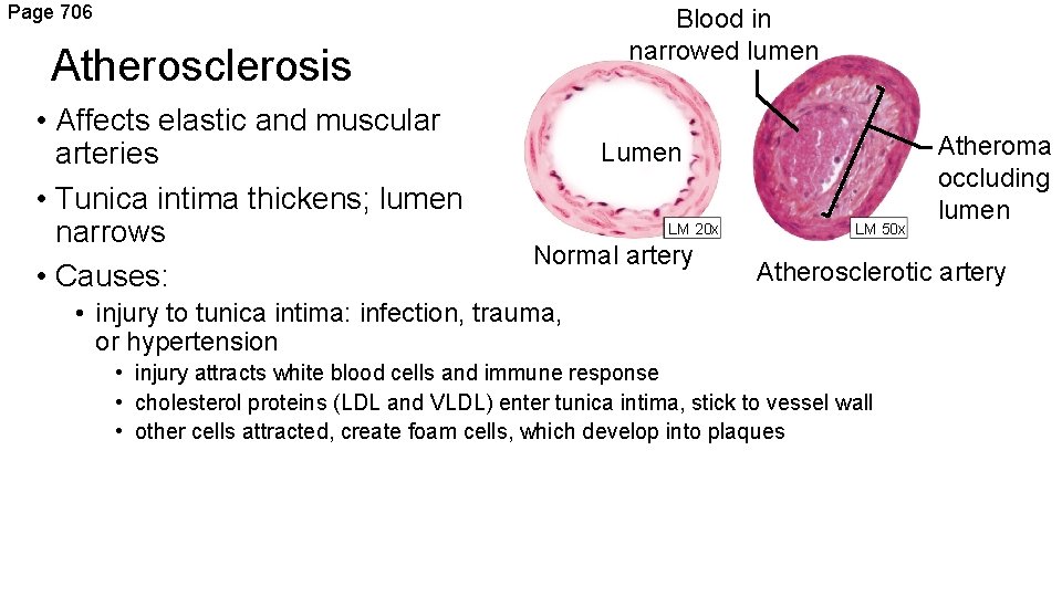 Page 706 Blood in narrowed lumen Atherosclerosis • Affects elastic and muscular arteries •