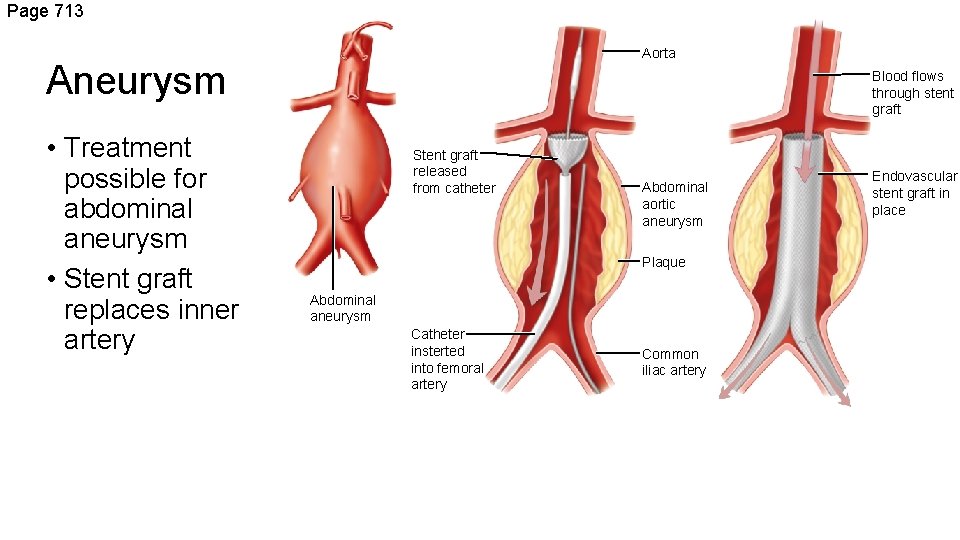 Page 713 Aorta Aneurysm • Treatment possible for abdominal aneurysm • Stent graft replaces