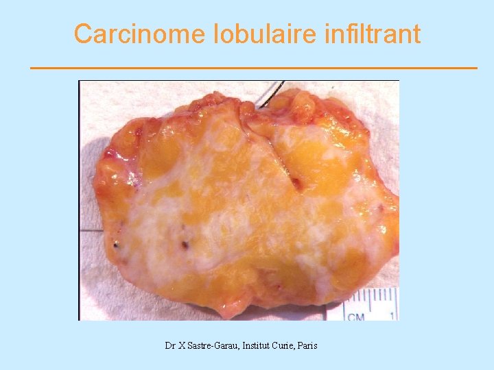 Carcinome lobulaire infiltrant Dr X Sastre-Garau, Institut Curie, Paris 