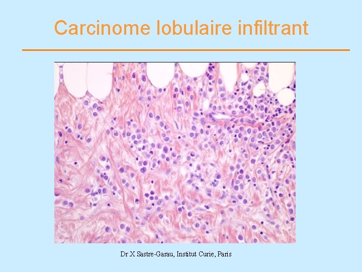 Carcinome lobulaire infiltrant Dr X Sastre-Garau, Institut Curie, Paris 