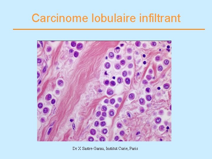 Carcinome lobulaire infiltrant Dr X Sastre-Garau, Institut Curie, Paris 