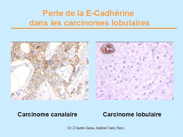 Perte de la E-Cadhérine dans les carcinomes lobulaires Carcinome canalaire Carcinome lobulaire Dr X