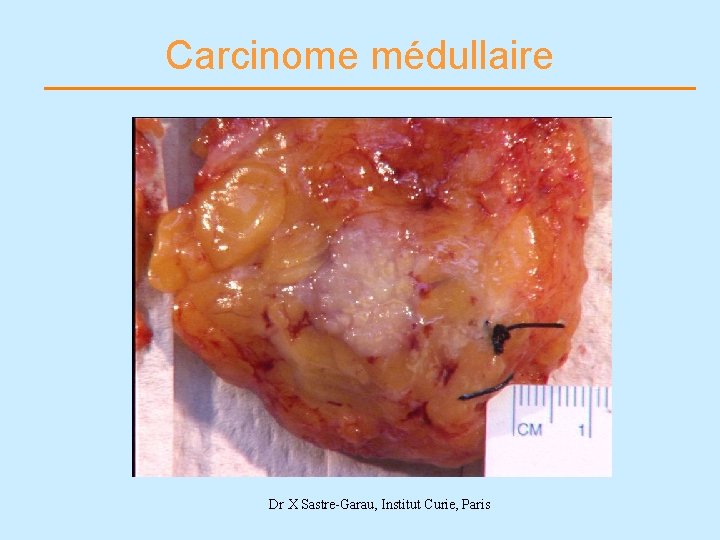 Carcinome médullaire Dr X Sastre-Garau, Institut Curie, Paris 