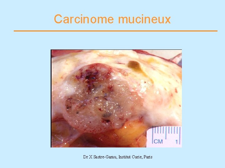 Carcinome mucineux Dr X Sastre-Garau, Institut Curie, Paris 