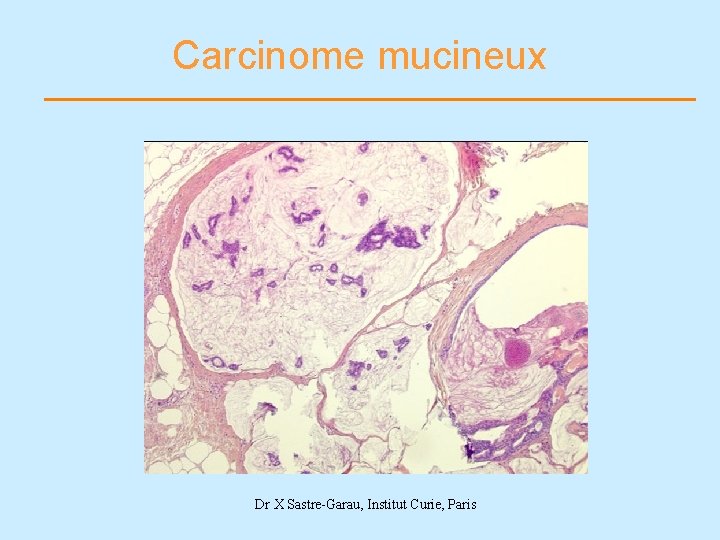Carcinome mucineux Dr X Sastre-Garau, Institut Curie, Paris 