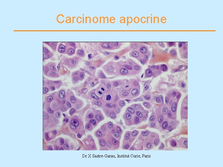 Carcinome apocrine Dr X Sastre-Garau, Institut Curie, Paris 
