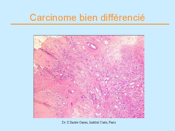 Carcinome bien différencié Dr X Sastre-Garau, Institut Curie, Paris 