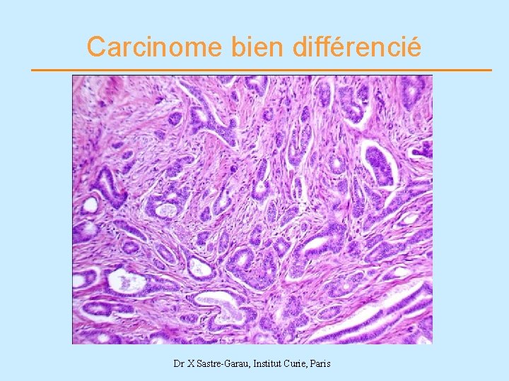 Carcinome bien différencié Dr X Sastre-Garau, Institut Curie, Paris 