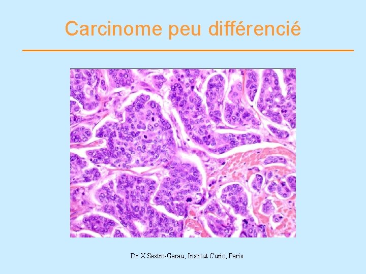 Carcinome peu différencié Dr X Sastre-Garau, Institut Curie, Paris 