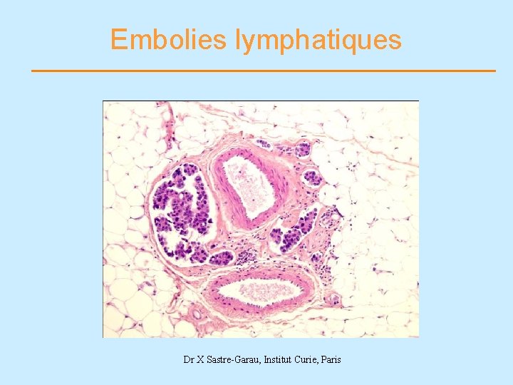 Embolies lymphatiques Dr X Sastre-Garau, Institut Curie, Paris 