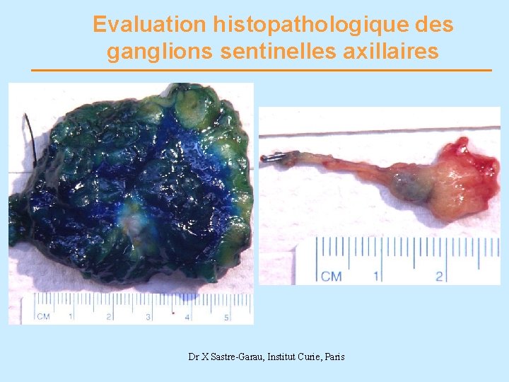 Evaluation histopathologique des ganglions sentinelles axillaires Dr X Sastre-Garau, Institut Curie, Paris 