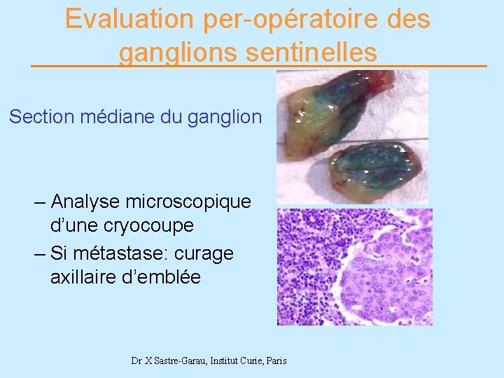 Evaluation per-opératoire des ganglions sentinelles Section médiane du ganglion – Analyse microscopique d’une cryocoupe