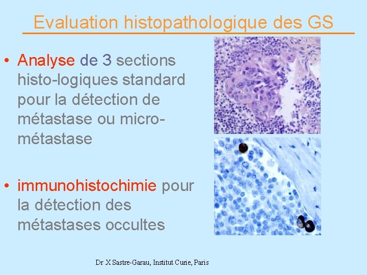 Evaluation histopathologique des GS • Analyse de 3 sections histo-logiques standard pour la détection