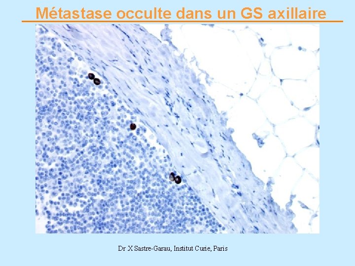 Métastase occulte dans un GS axillaire Dr X Sastre-Garau, Institut Curie, Paris 