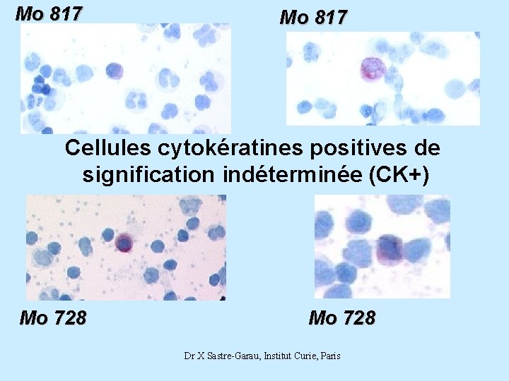 Mo 817 Cellules cytokératines positives de signification indéterminée (CK+) Mo 728 Dr X Sastre-Garau,