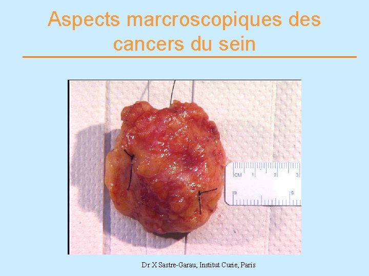 Aspects marcroscopiques des cancers du sein Dr X Sastre-Garau, Institut Curie, Paris 