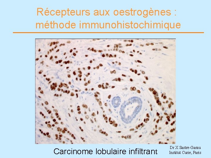 Récepteurs aux oestrogènes : méthode immunohistochimique Carcinome lobulaire infiltrant Dr X Sastre-Garau Institut Curie,