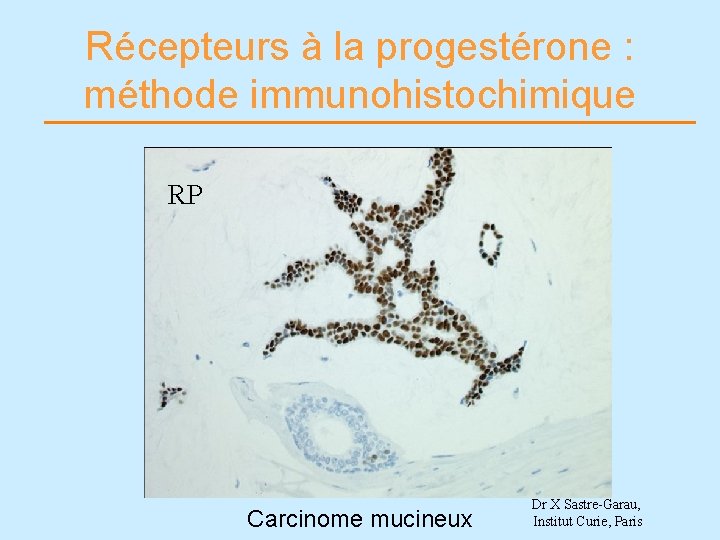 Récepteurs à la progestérone : méthode immunohistochimique RP Carcinome mucineux Dr X Sastre-Garau, Institut