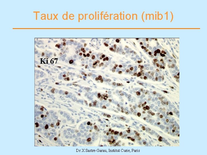 Taux de prolifération (mib 1) Ki 67 Dr X Sastre-Garau, Institut Curie, Paris 