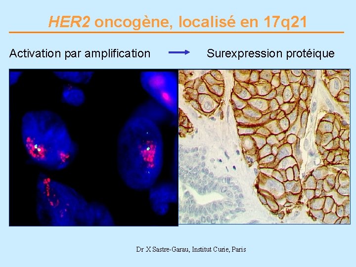 HER 2 oncogène, localisé en 17 q 21 Activation par amplification Surexpression protéique Dr