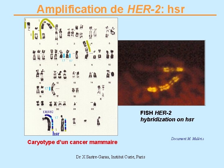 Amplification de HER-2: hsr FISH HER-2 hybridization on hsr Caryotype d’un cancer mammaire Dr
