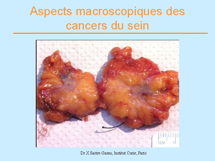 Aspects macroscopiques des cancers du sein Dr X Sastre-Garau, Institut Curie, Paris 