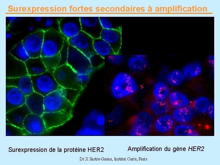 Surexpression fortes secondaires à amplification Surexpression de la protéine HER 2 Amplification du gène