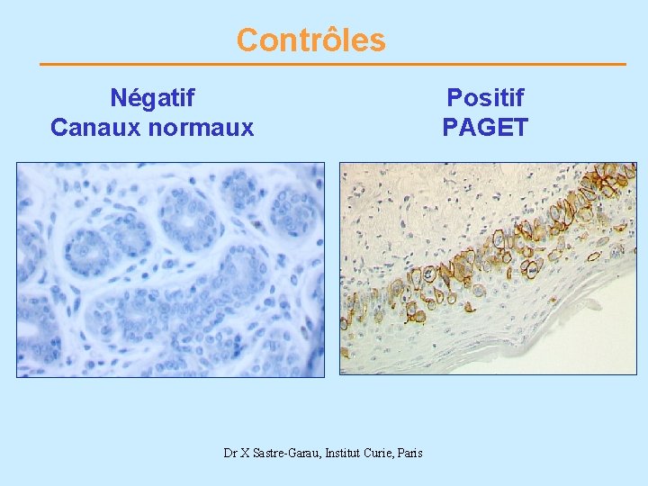 Contrôles Négatif Canaux normaux Dr X Sastre-Garau, Institut Curie, Paris Positif PAGET 