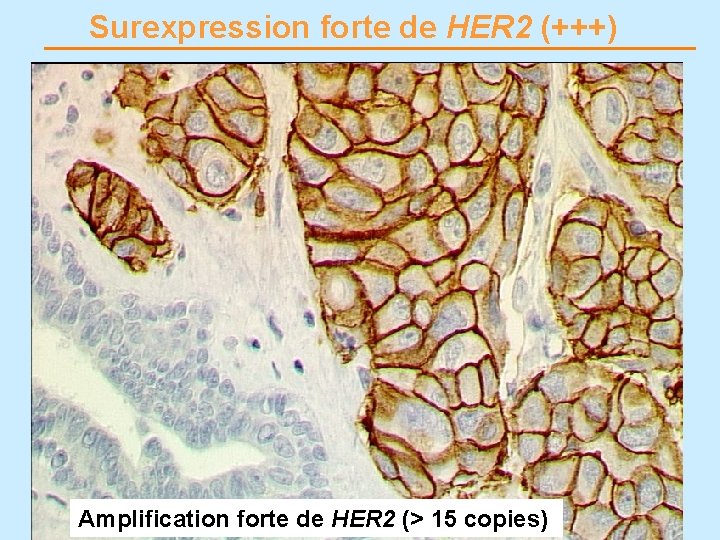 Surexpression forte de HER 2 (+++) Dr X Sastre-Garau, Institut Curie, Paris Amplification forte