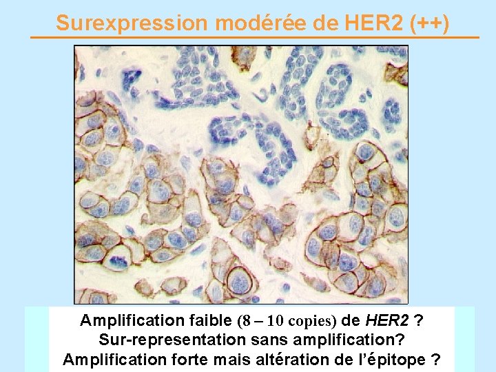 Surexpression modérée de HER 2 (++) Amplification faible (8 – 10 copies) de HER