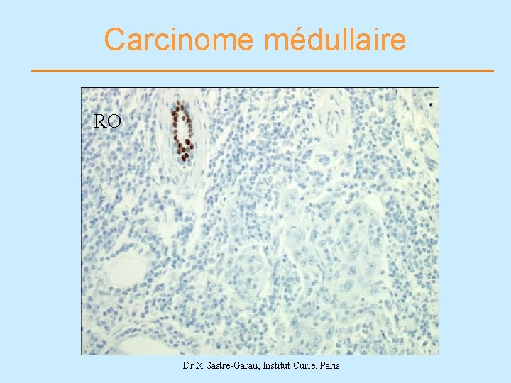 Carcinome médullaire RO Dr X Sastre-Garau, Institut Curie, Paris 