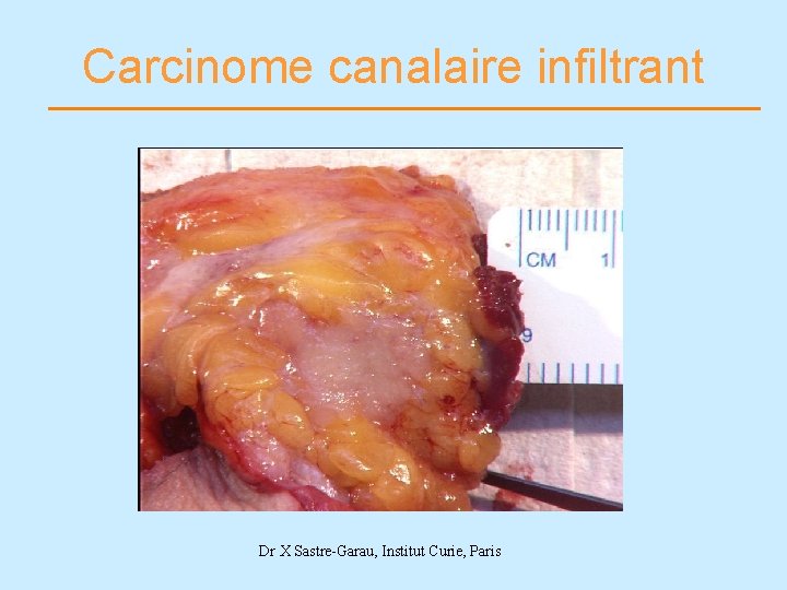 Carcinome canalaire infiltrant Dr X Sastre-Garau, Institut Curie, Paris 