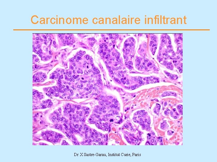 Carcinome canalaire infiltrant Dr X Sastre-Garau, Institut Curie, Paris 