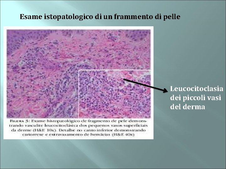 Esame istopatologico di un frammento di pelle Leucocitoclasia dei piccoli vasi del derma 