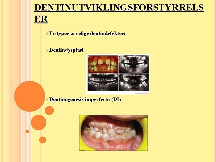 DENTINUTVIKLINGSFORSTYRRELS ER ØTo typer arvelige dentindefekter: ØDentindysplasi ØDentinogenesis imperfecta (DI) DENTINUTVIKLINGSFORSTYRRELS ER ØTo typer arvelige dentindefekter: ØDentindysplasi ØDentinogenesis imperfecta (DI)