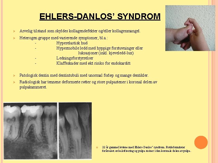 EHLERS-DANLOS’ SYNDROM Ø Arvelig tilstand som skyldes kollagendefekter og/eller kollagenmangel. Ø Heterogen gruppe med EHLERS-DANLOS’ SYNDROM Ø Arvelig tilstand som skyldes kollagendefekter og/eller kollagenmangel. Ø Heterogen gruppe med