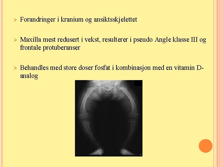 Ø Forandringer i kranium og ansiktsskjelettet Ø Maxilla mest redusert i vekst, resulterer i Ø Forandringer i kranium og ansiktsskjelettet Ø Maxilla mest redusert i vekst, resulterer i